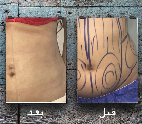 شفط البطن